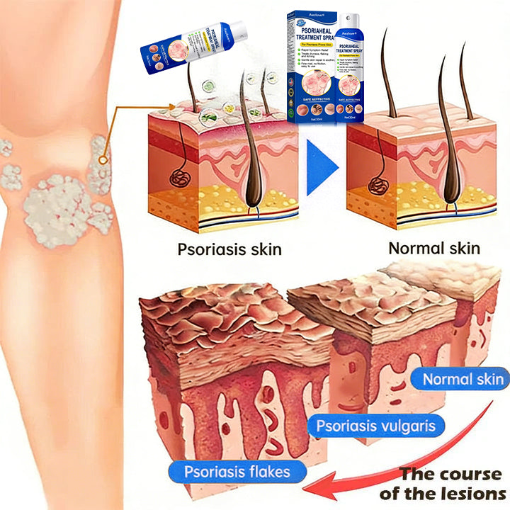 Awzlove® PsoriaHeal  Treatment Spray(Suitable for all skin conditions)