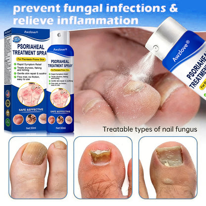 Awzlove® PsoriaHeal  Treatment Spray(Suitable for all skin conditions)
