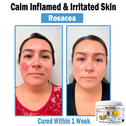 TODAHOF™ Bee Venom Multi-Symptom Skin Treatment Cream (👨‍⚕NPF RECOMMENDS)