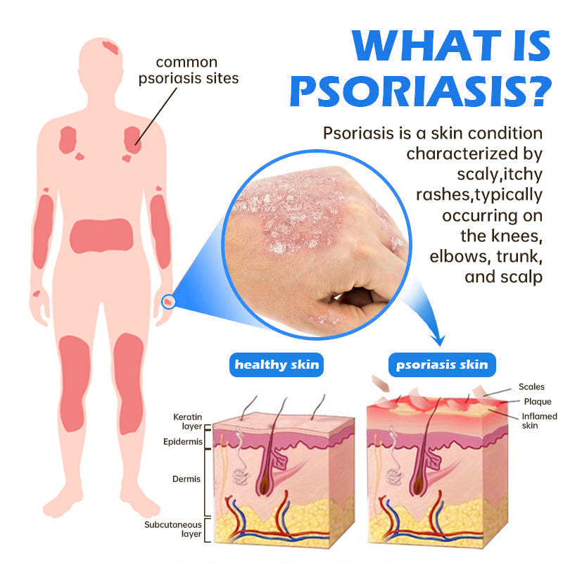 Awzlove® PsoriaHeal  Treatment Spray(Suitable for all skin conditions)