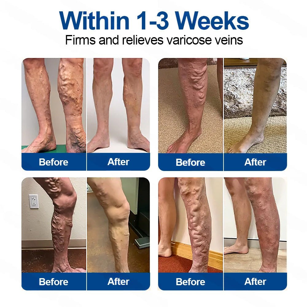 🇺🇸👨‍⚕️👍✅Healrize® VeinTarget Microneedle Patch⚡Instant Relief, Long-Term Results🎁