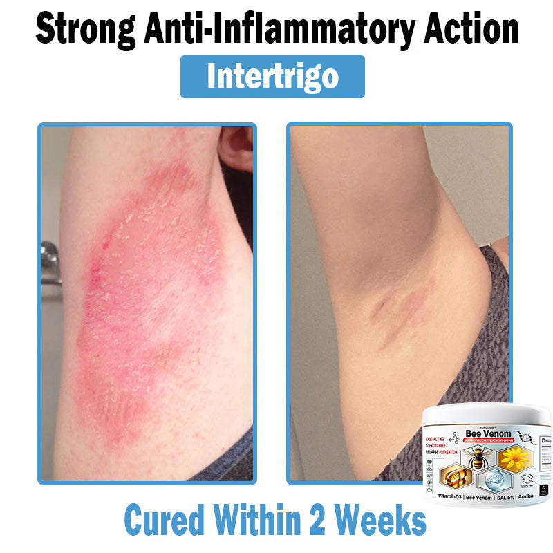TODAHOF™ Bee Venom Multi-Symptom Skin Treatment Cream (👨‍⚕NPF RECOMMENDS)