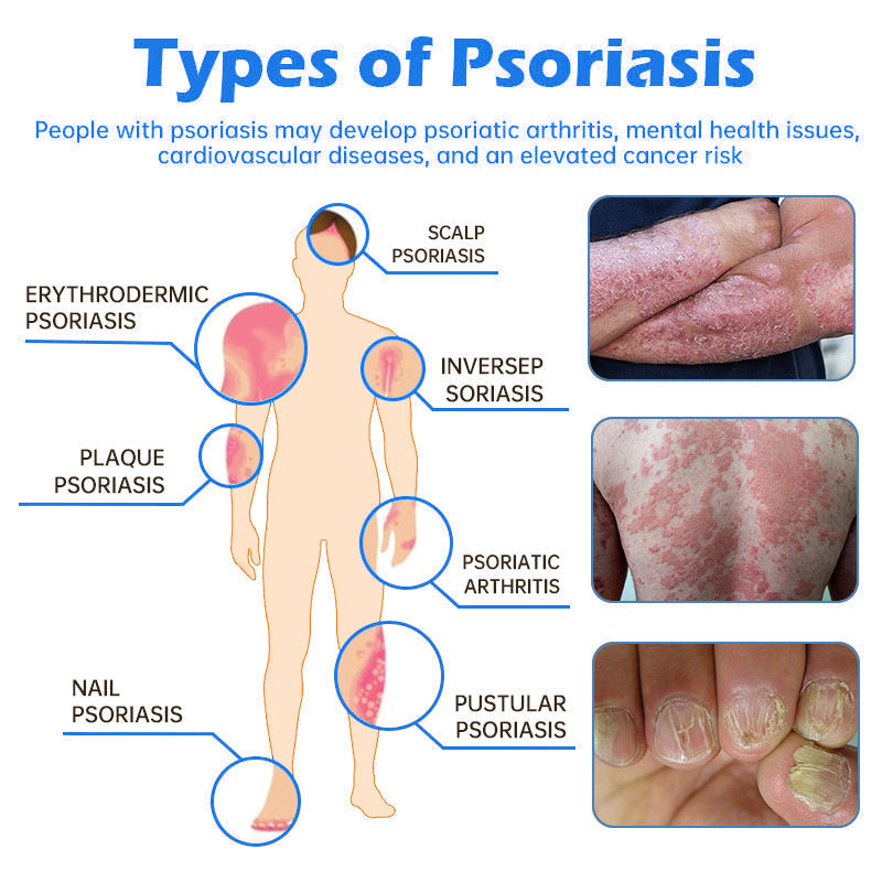 Awzlove® PsoriaHeal  Treatment Spray(Suitable for all skin conditions)