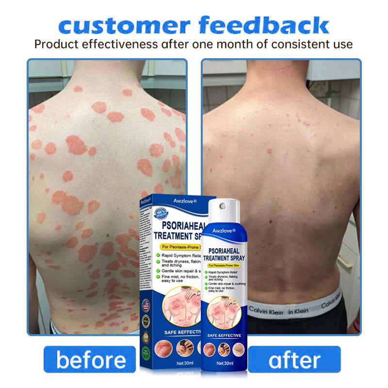 Awzlove® PsoriaHeal  Treatment Spray(Suitable for all skin conditions)