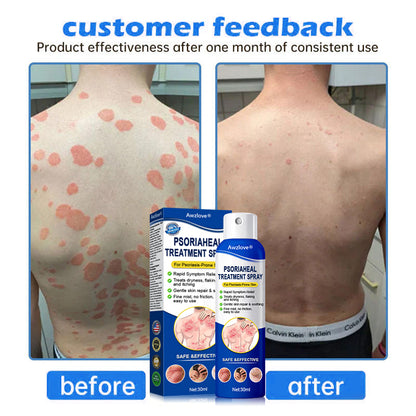 Awzlove® PsoriaHeal  Treatment Spray(Suitable for all skin conditions)