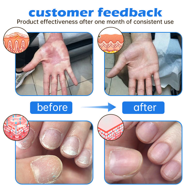 Awzlove® PsoriaHeal  Treatment Spray(Suitable for all skin conditions)