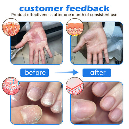 Awzlove® PsoriaHeal  Treatment Spray(Suitable for all skin conditions)
