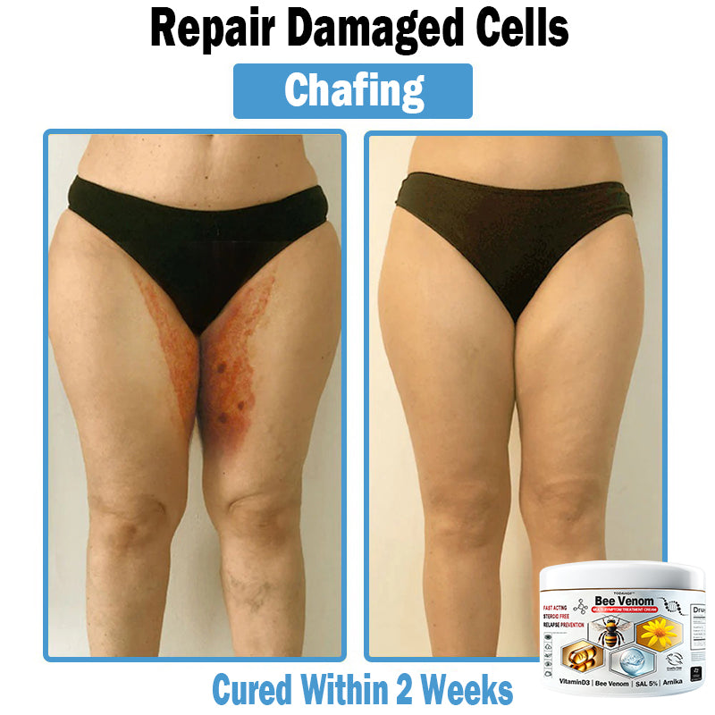 TODAHOF™ Bee Venom Multi-Symptom Skin Treatment Cream (👨‍⚕NPF RECOMMENDS)