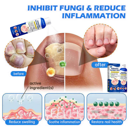 Awzlove® PsoriaHeal  Treatment Spray(Suitable for all skin conditions)