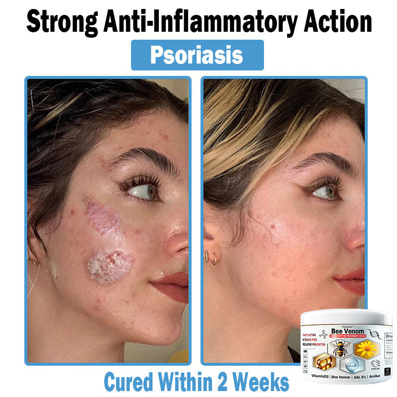 TODAHOF™ Bee Venom Multi-Symptom Skin Treatment Cream (👨‍⚕NPF RECOMMENDS)