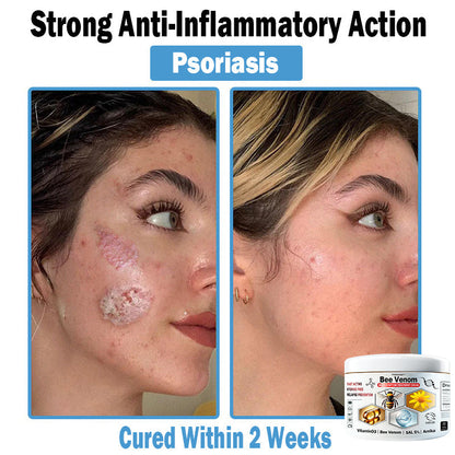 TODAHOF™ Bee Venom Multi-Symptom Skin Treatment Cream (👨‍⚕NPF RECOMMENDS)
