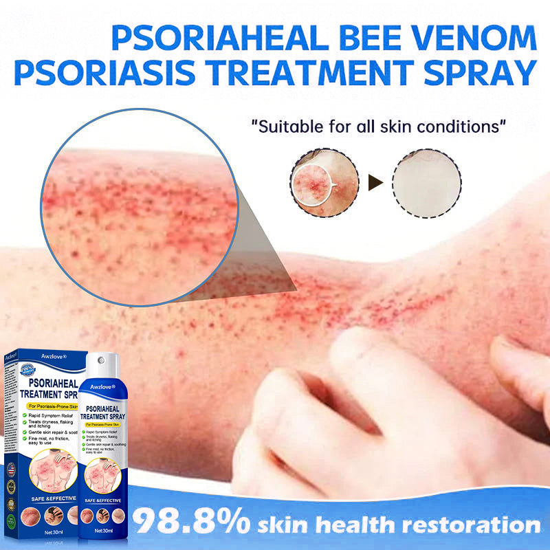 Awzlove® PsoriaHeal  Treatment Spray(Suitable for all skin conditions)