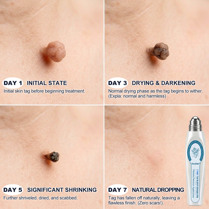 𝐇e𝐚𝐥𝐫i𝐳e® 7-𝐷𝑎𝑦 𝗧𝐚𝐠 & 𝗦𝗽𝐨𝐭 𝐄𝐫𝒂𝒔𝒆𝒓(Zero Pain, Zero 𝐒𝐜𝐚𝒓𝒔 Rollerball)💯